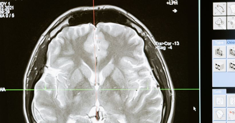 Radiografía cerebral. Mart production.